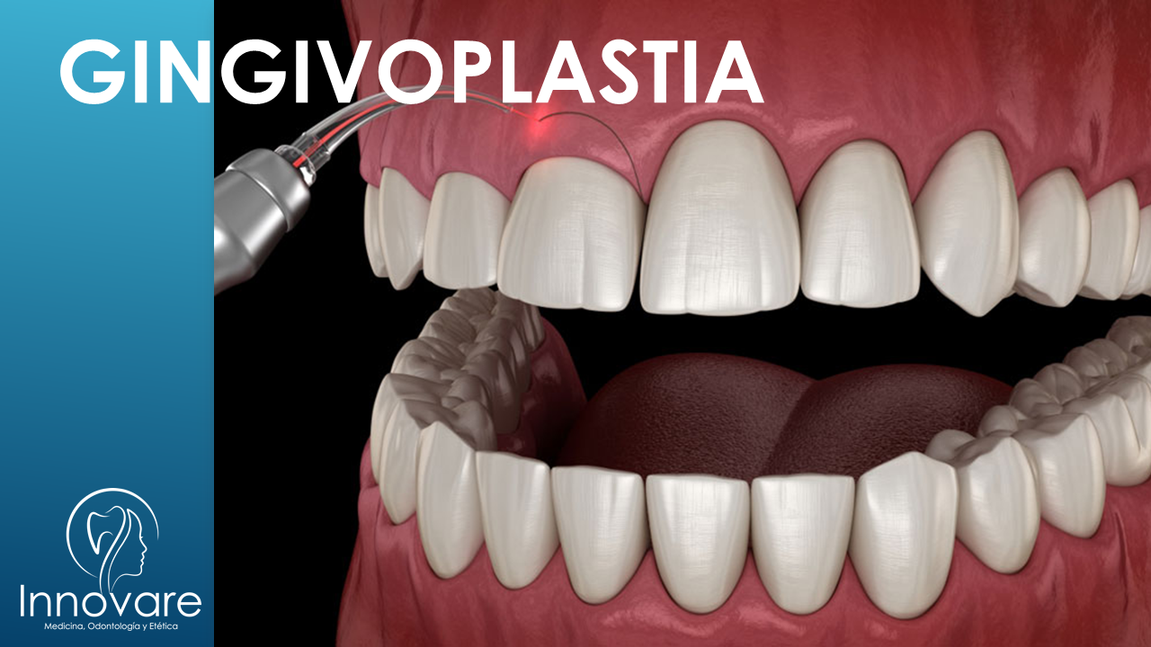 Gingivoplastia